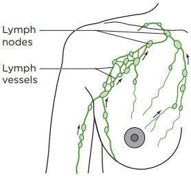 Understanding Breast Cancer" Related" Lymphedema: